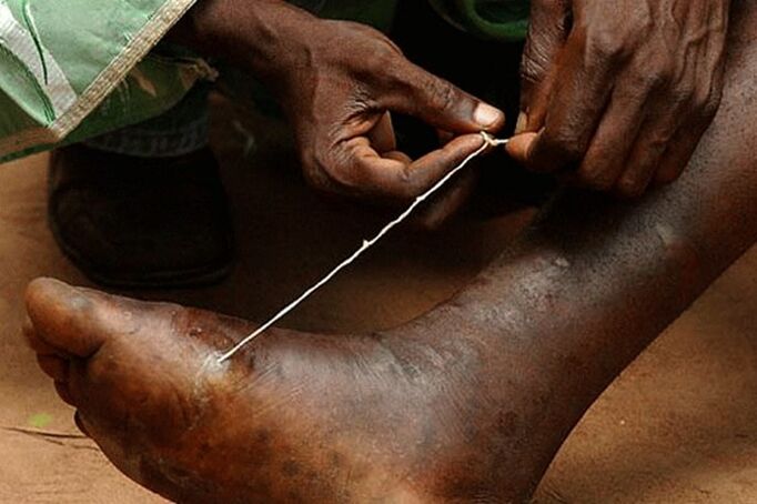 subcutaneous worm parasitic of the Guinea worm